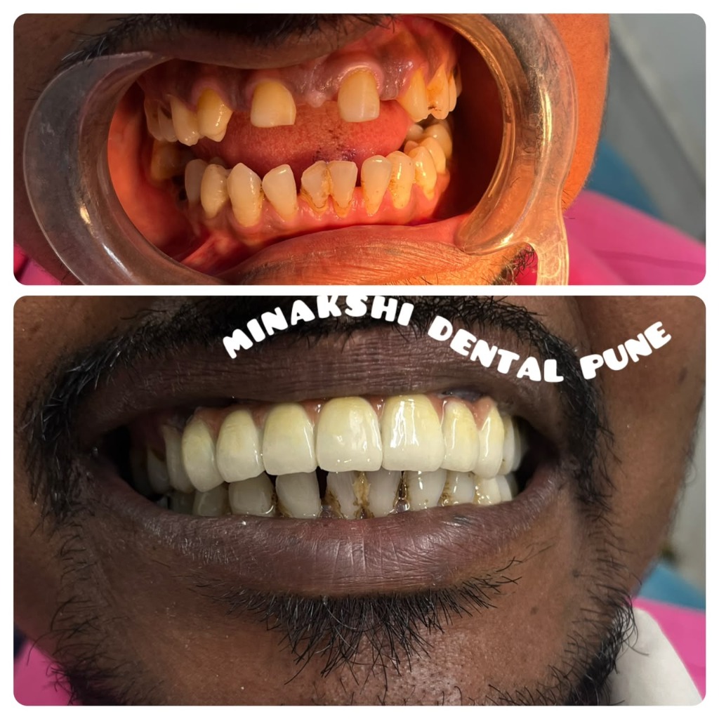 Before and After Smile Transformation at Minakshi Dental Clinic Pune