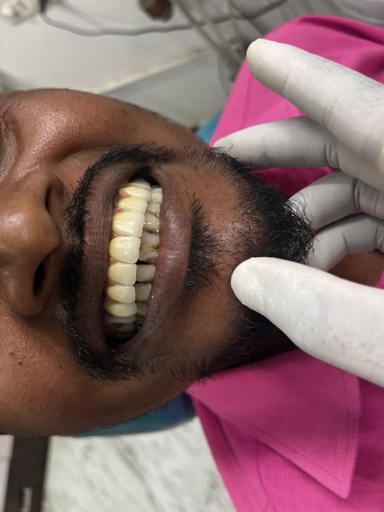 Fixed Partial Denture FPD Ceramic Bridge smile delivery