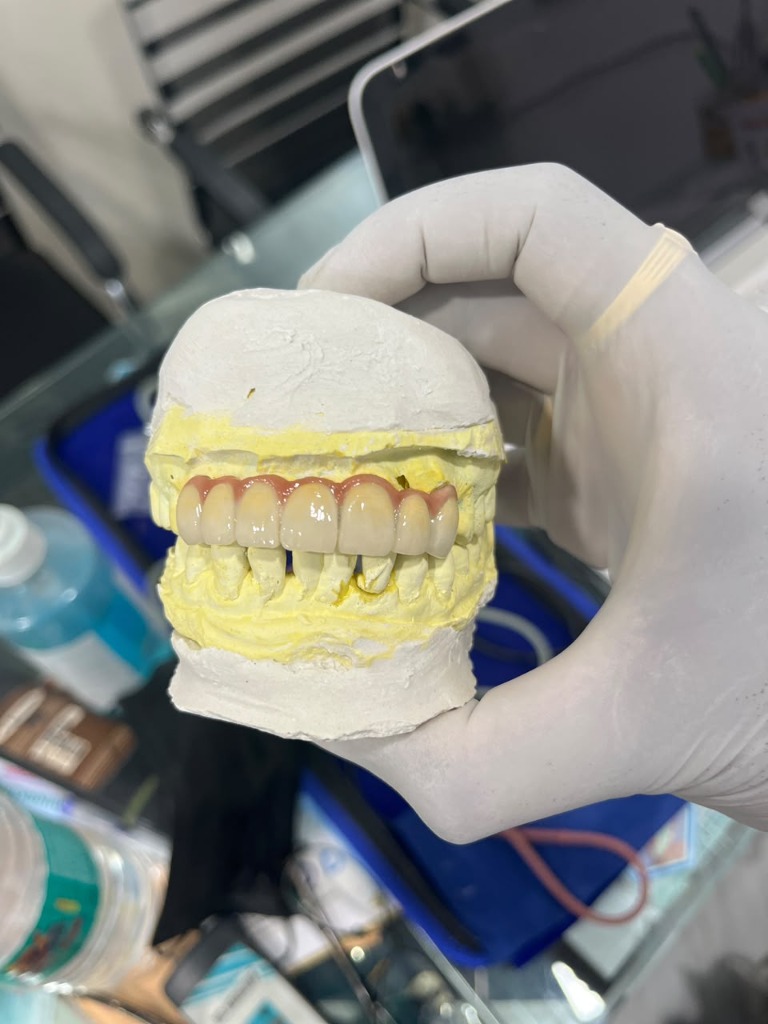 Custom Dental Lab Cast with Fixed Partial Denture Bridge