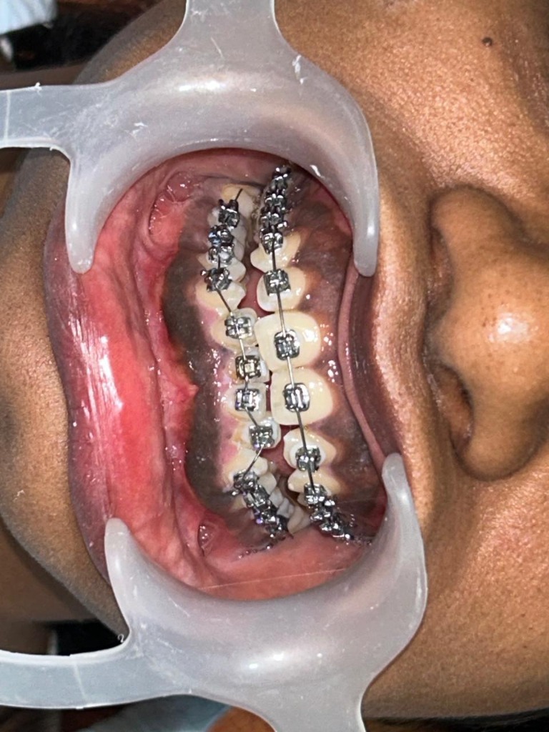 Comprehensive Dual Arch Orthodontic Braces Bonding Procedure
