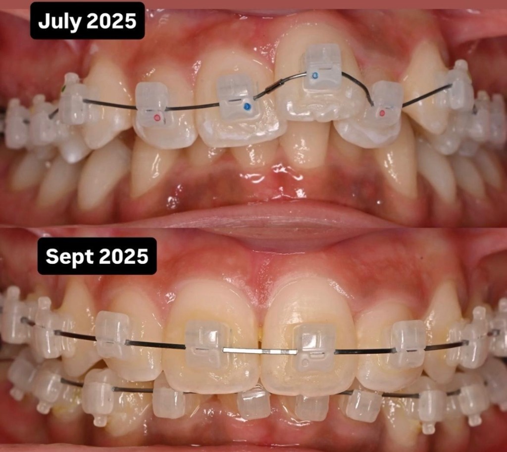 Orthodontic Ceramic Braces Progress July 2025 to Sept 2025