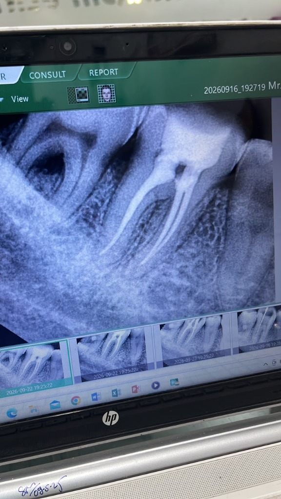 Computerized RVG Digital X-ray showing successful Root Canal Treatment RCT